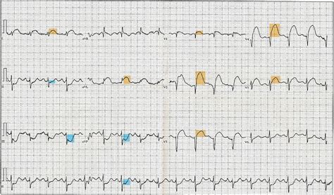 Electrocardiography In Myocardial Infarction Wikipedia