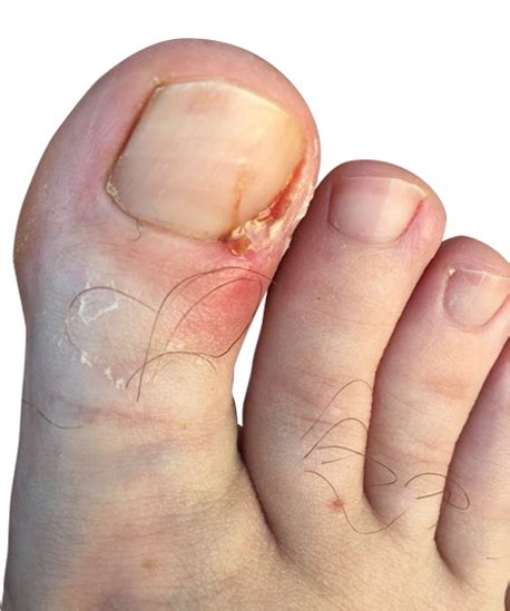 Pedicure Gone Wrong Dubai Podiatry Centre