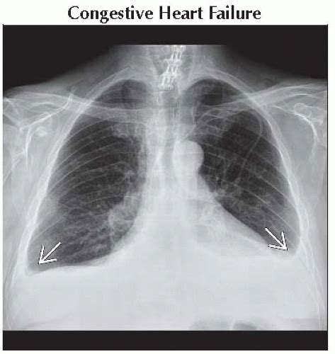 Bilateral Pleural Effusion Thoracic Key