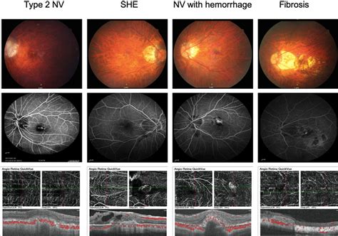 Color Fundus Photographs And Fluorescein Angiography And Oct Download Scientific Diagram