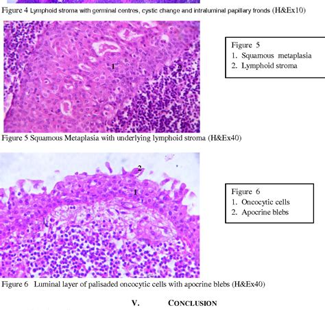 Figure 1 from Fine Needle Aspiration Cytology of Warthin’s Tumor: A ...