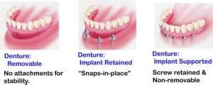 Snap On Dentures Vs All On Permanent Implants