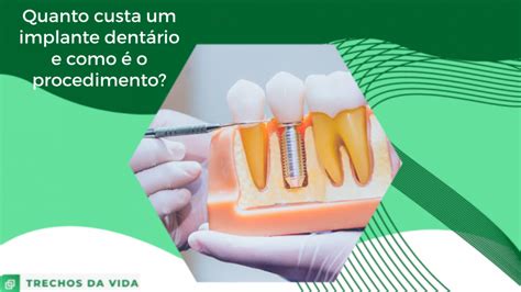 Quanto custa um implante dentário e como é o procedimento