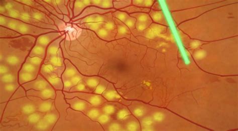 Tudo Sobre O Tratamento Da Retinopatia Diab Tica E Edema Macular