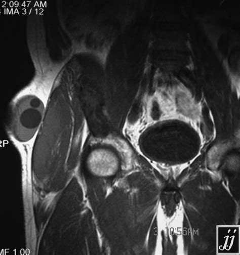 Right Gluteal Region Abscess Radiopaedia