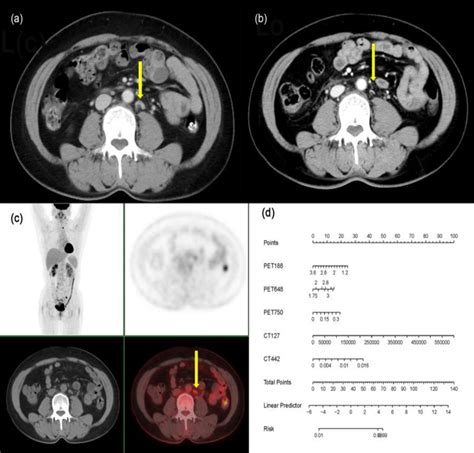 The yellow arrows indicate the para-aortic lymph node. The patient, a... | Download Scientific ...