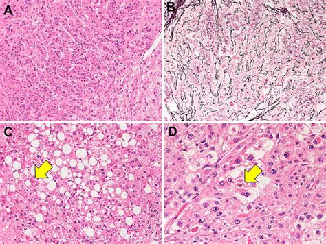 Figure6 Histological Findings Of The Resected Specimen Revealing