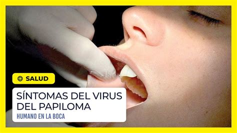 Síntomas del virus del papiloma humano en la boca YouTube