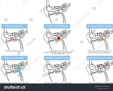 Types Symptoms Ear Diseases Stock Vector (Royalty Free) 2180280085 ...