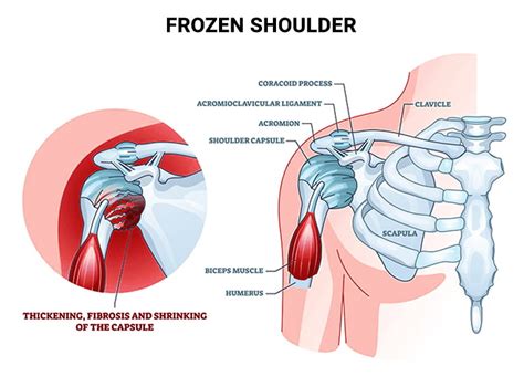 Shoulder Injury Treatment Nj Shoulder Injury Doctors Specialists In