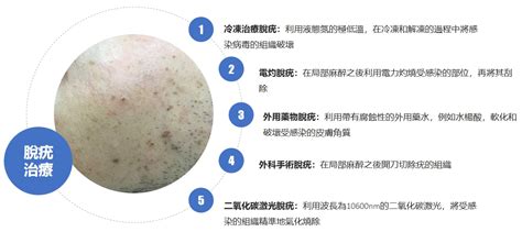 生疣點算？皮膚科醫生：5種脫疣治療方法！去疣注意事項一覽 確研皮膚專科中心