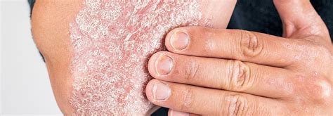 Psoriasis Behandlung Welche Tipps Wirklich Helfen Hautinfo At