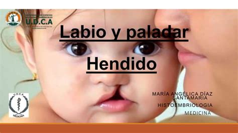 Labio Y Paladar Hendido Ppt