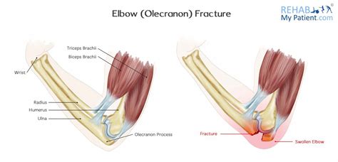 Biceps Brachii Fracture Rehab Elbow Bobby Pins Medicine Wrist