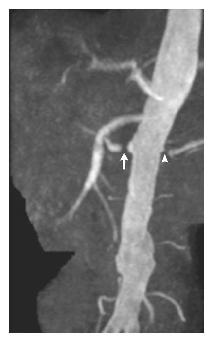 Renal Artery Stenosis Nejm