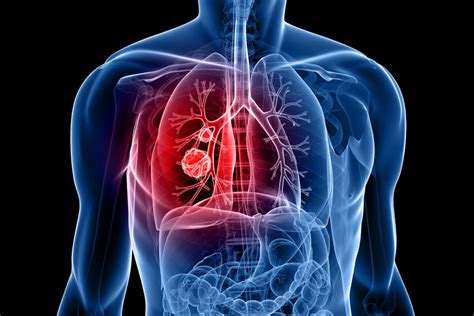 Pulmonary Diseases