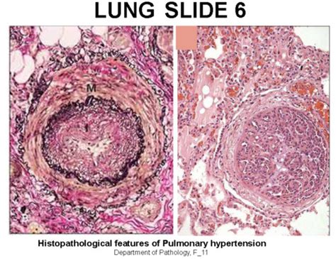 Pulmonary Vascular Disease 1 10 17 Flashcards Quizlet