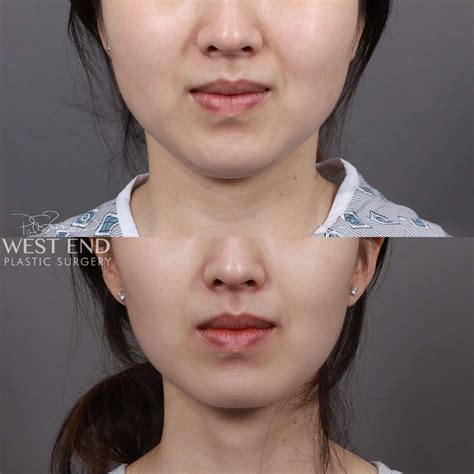 Liposuction And Buccal Fat Pad Removal Case 9367 West End Plastic Surgery