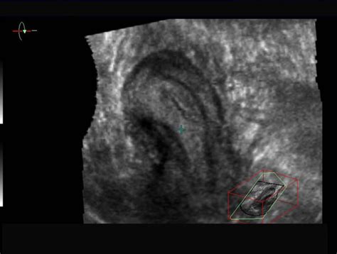 Icono 3 Echographie des malformations utérines