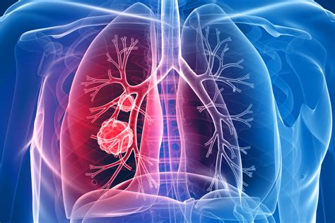 Cancerul Pulmonar Simptome Simptome Ale Cancerului Pulmonar The Best