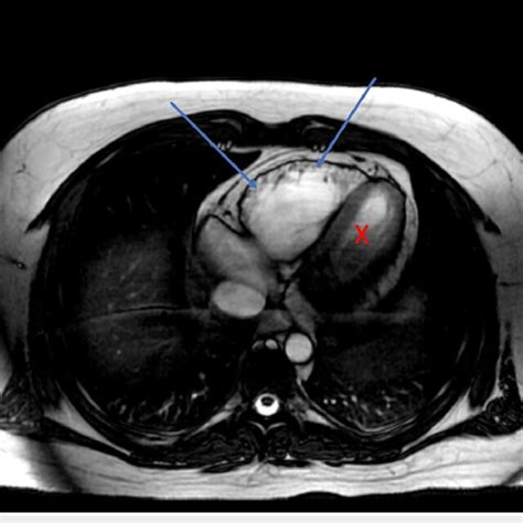 Cardiac Mri With Blue Arrows Indicating Right Ventricular Dilation Download Scientific Diagram