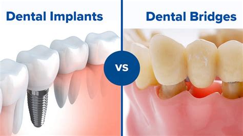 Dental Implant or Bridge Which is Better: Bridge vs Implant Pros Cons ...