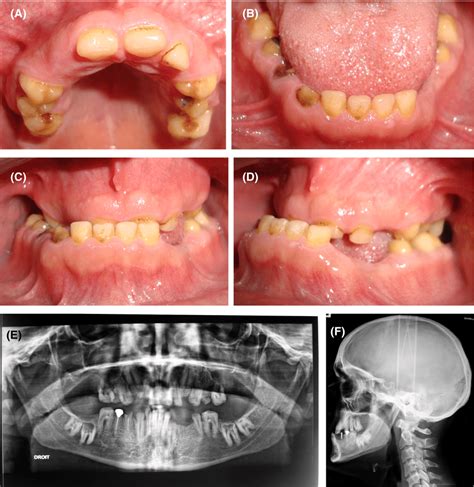 Initial Clinical Data A Occlusal View Of The Maxillary Arch B Download Scientific Diagram