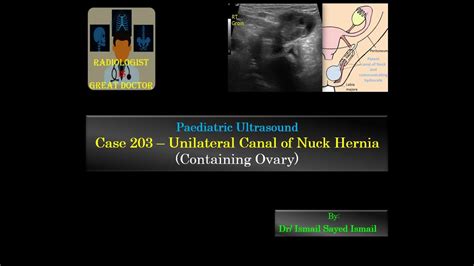 Ultrasound Case 203 - Ovary-containing Canal of Nuck Hernia - YouTube