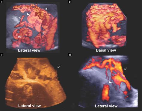 Role Of Three‐dimensional Power Doppler In The Antenatal Diagnosis Of Placenta Accreta