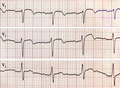 Sytuacje Kliniczne Imituj Ce Ostry Zesp Wie Cowy Ostra Zatorowo