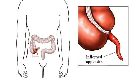 Appendix Everyday Health