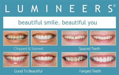 Lumineers Annapolis Md Dental Veneers For Damaged Teeth