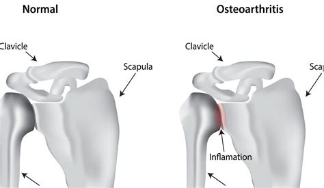 Corticosteroids Injections for Shoulder Arthritis - Wayne, NJ - High ...