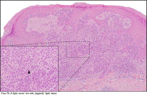 Next‐generation Sequencing Improves Agreement And Accuracy In The Diagnosis Of Spitz And