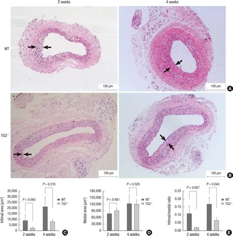 Intimal Hyperplasia Is Significantly Reduced In Tg2 Null Mice After