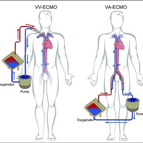 Modalities Of Extracorporeal Membrane Oxygenation Va Venoarterial