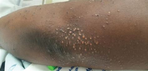 An Unusual Presentation Of Eruptive Xanthoma A Case Report And