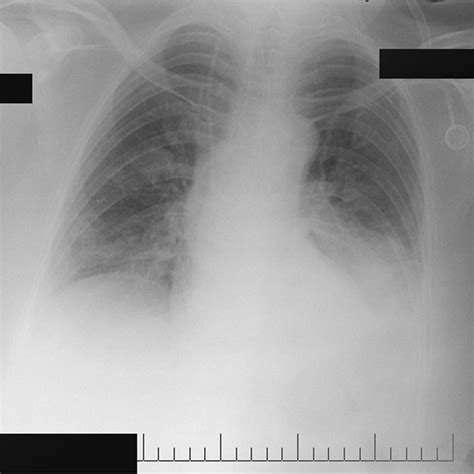 Chest Radiography Showed A Small Area Of Right Perihilar Infiltration