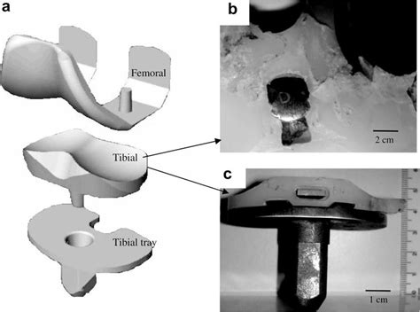 Knee Prosthesis A Schematic Prosthesis Components B Top View Of Download Scientific