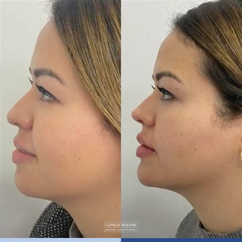 Armonizaci N Facial Qu Es Y Cu Les Son Sus Beneficios Cl Nicas