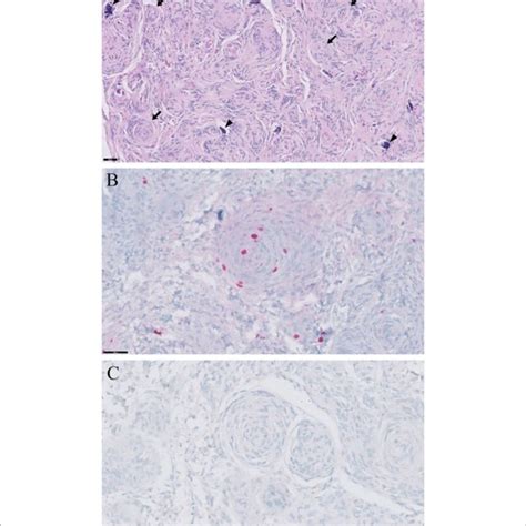 Histopathological And Immunohistochemical Findings Of Meningioma In A Download Scientific