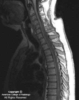 Neuroradiology On The Net Spinal Epidural Abscess