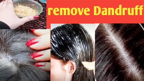 Miracle Home Remedy To Remove Dandruff At Home Dandruff Treatment