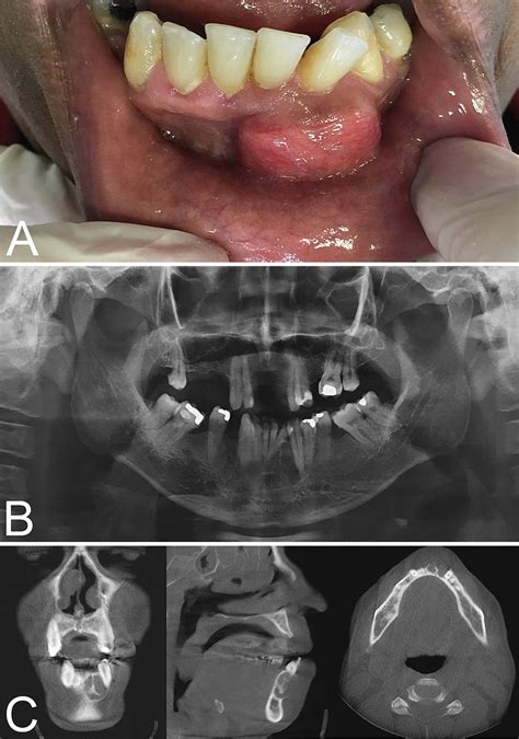 A Sessile Nodule With A Smooth Surface 25 Cm In Diameter In The