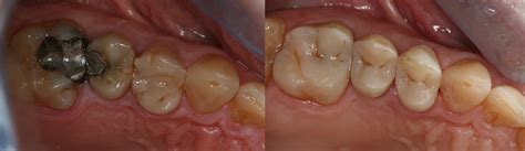 Casos Clínicos de Odontología Conservadora Clínica Dental MAIP