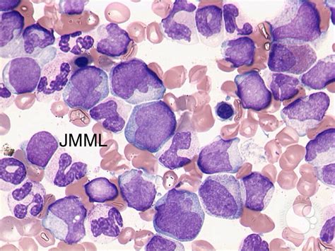 Types Leukemia