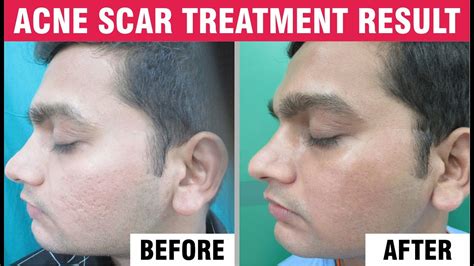 Acne Scars Treatment Sakhiya Skin Clinic Review YouTube