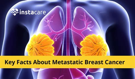 Key Facts About Metastatic Breast Cancer