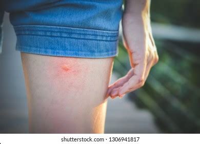 Mosquito Bite Woman Images Browse Stock Photos Vectors Free