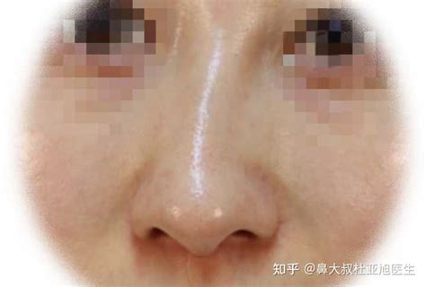 歪鼻矫正一定要截骨吗？歪鼻矫正以后还会歪吗？ 知乎